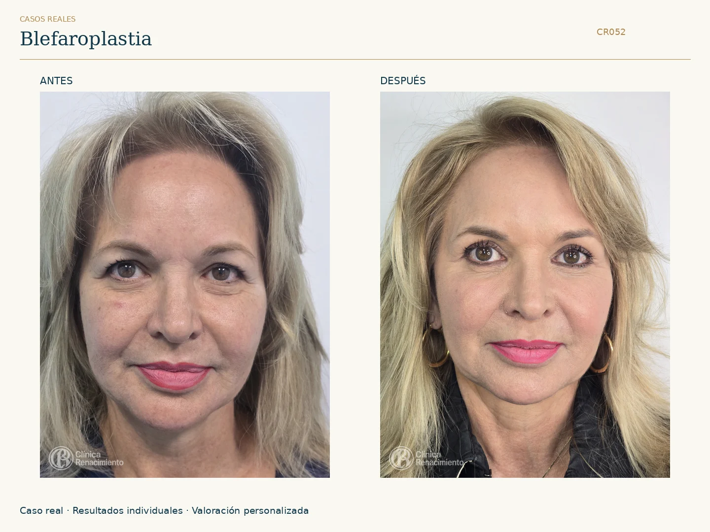 Párpados: antes y después, vista frontal. Caso CR052 de Clínica Renacimiento Madrid.