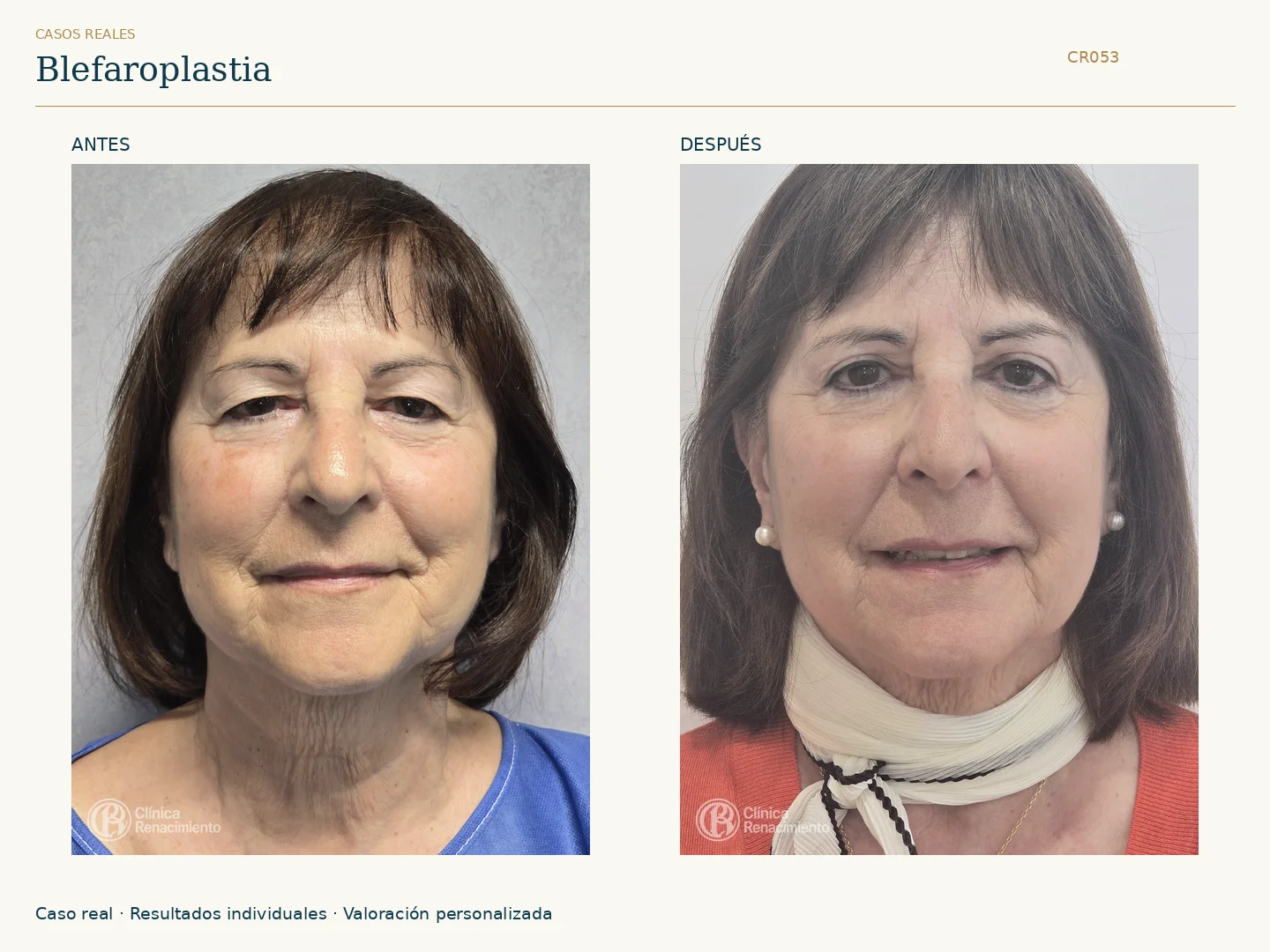 Párpados: antes y después, vista frontal. Caso CR053 de Clínica Renacimiento Madrid.