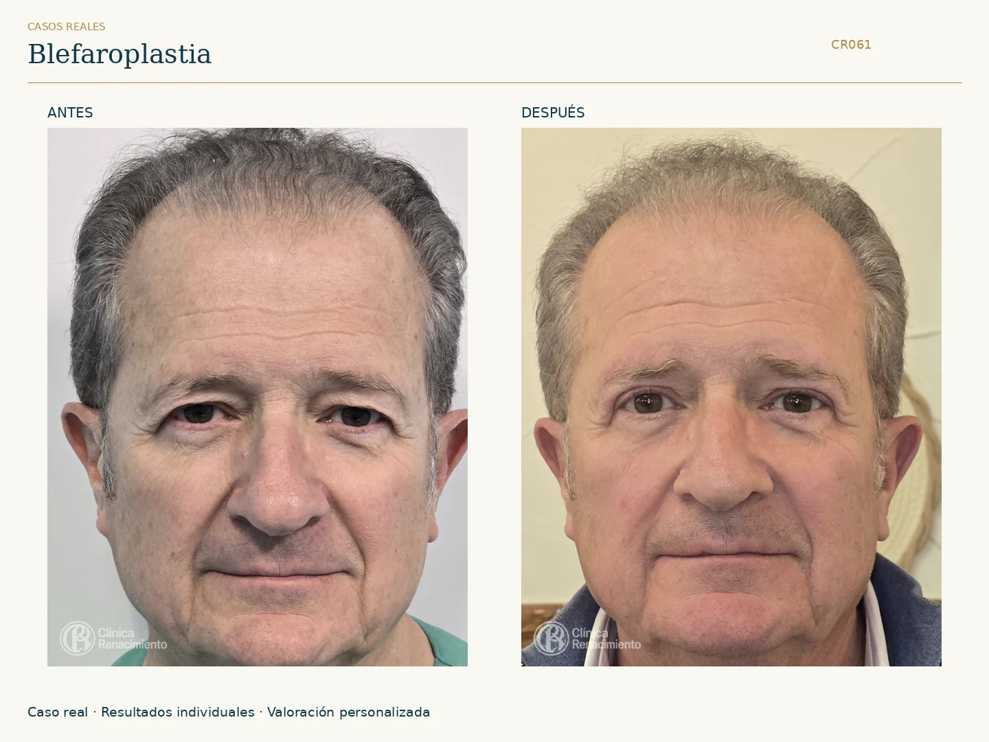 Párpados: antes y después, vista frontal. Caso CR061 de Clínica Renacimiento Madrid.