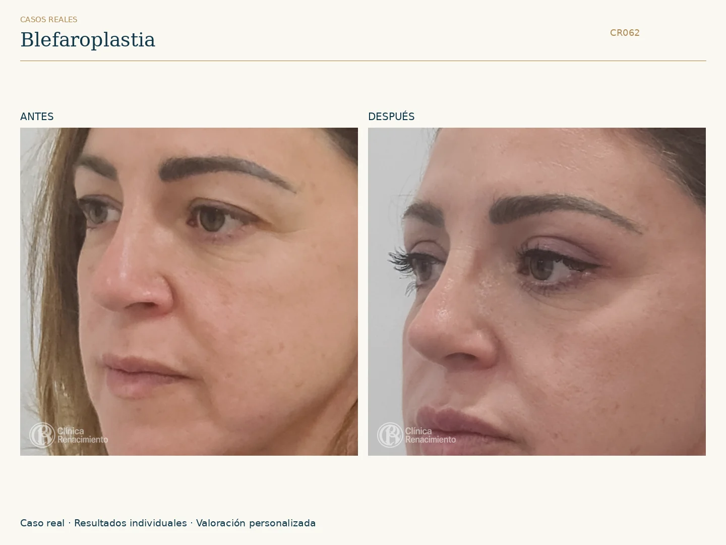Párpados: antes y después, vista oblicua derecha. Caso CR062 de Clínica Renacimiento Madrid.