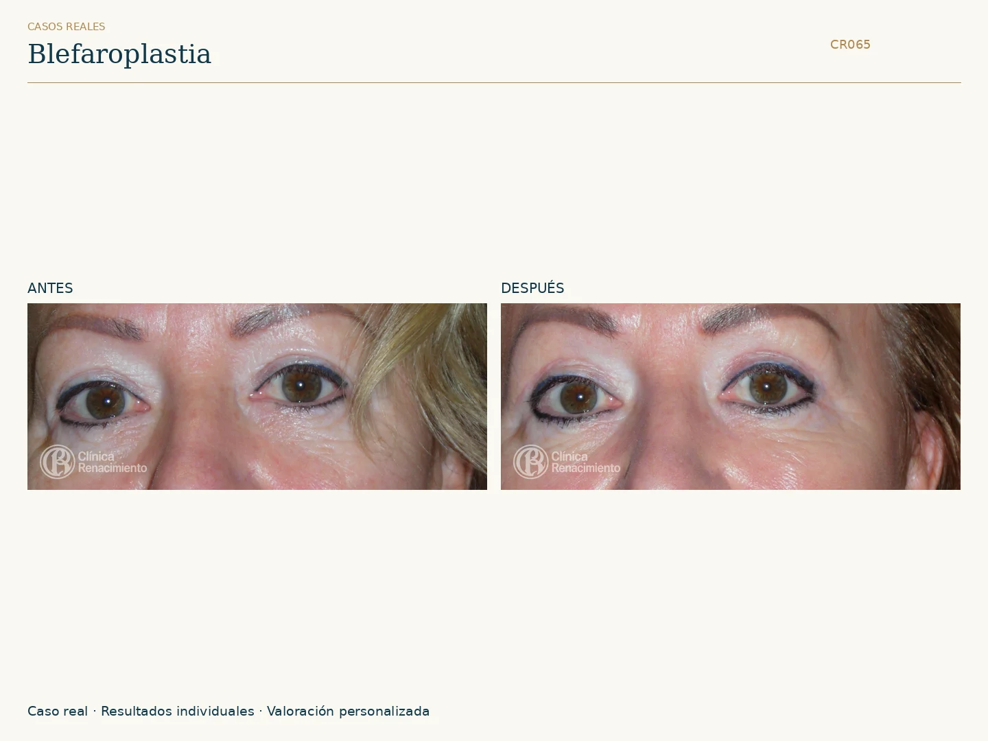 Párpados: antes y después, vista frontal. Caso CR065 de Clínica Renacimiento Madrid.