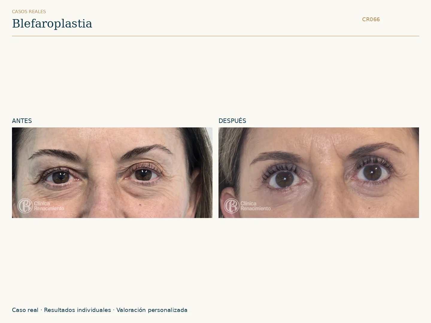 Párpados: antes y después, vista frontal. Caso CR066 de Clínica Renacimiento Madrid.
