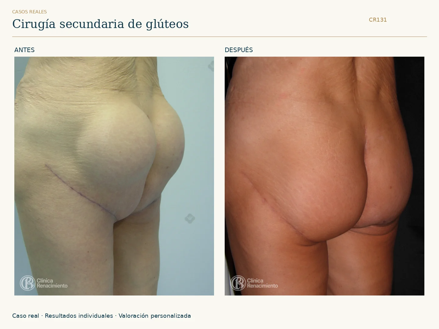 Cirugía secundaria: antes y después, vista oblicua. Caso CR131 de Clínica Renacimiento Madrid.