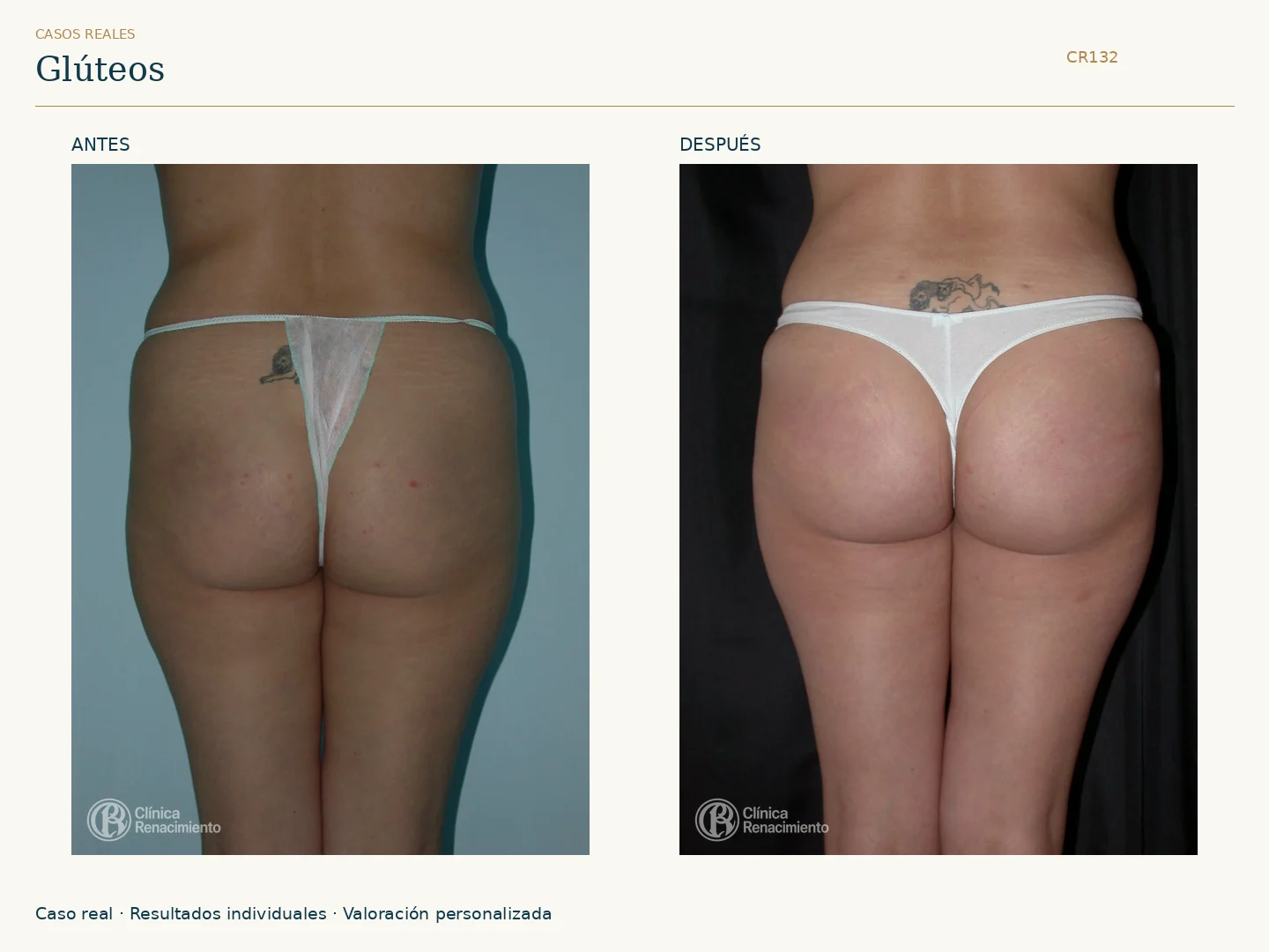Glúteos: antes y después, vista posterior. Caso CR132 de Clínica Renacimiento Madrid.