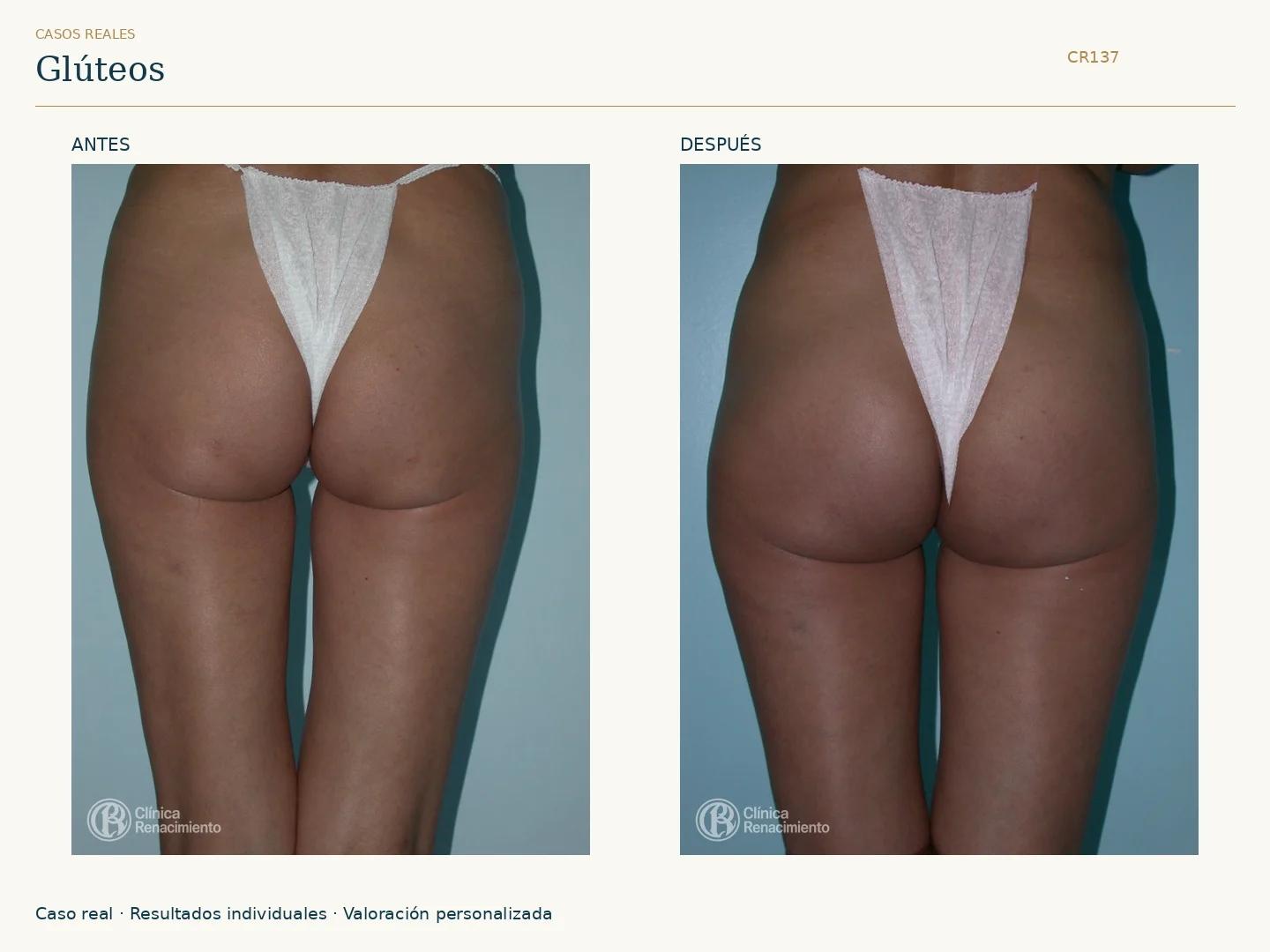 Glúteos: antes y después, vista posterior. Caso CR137 de Clínica Renacimiento Madrid.