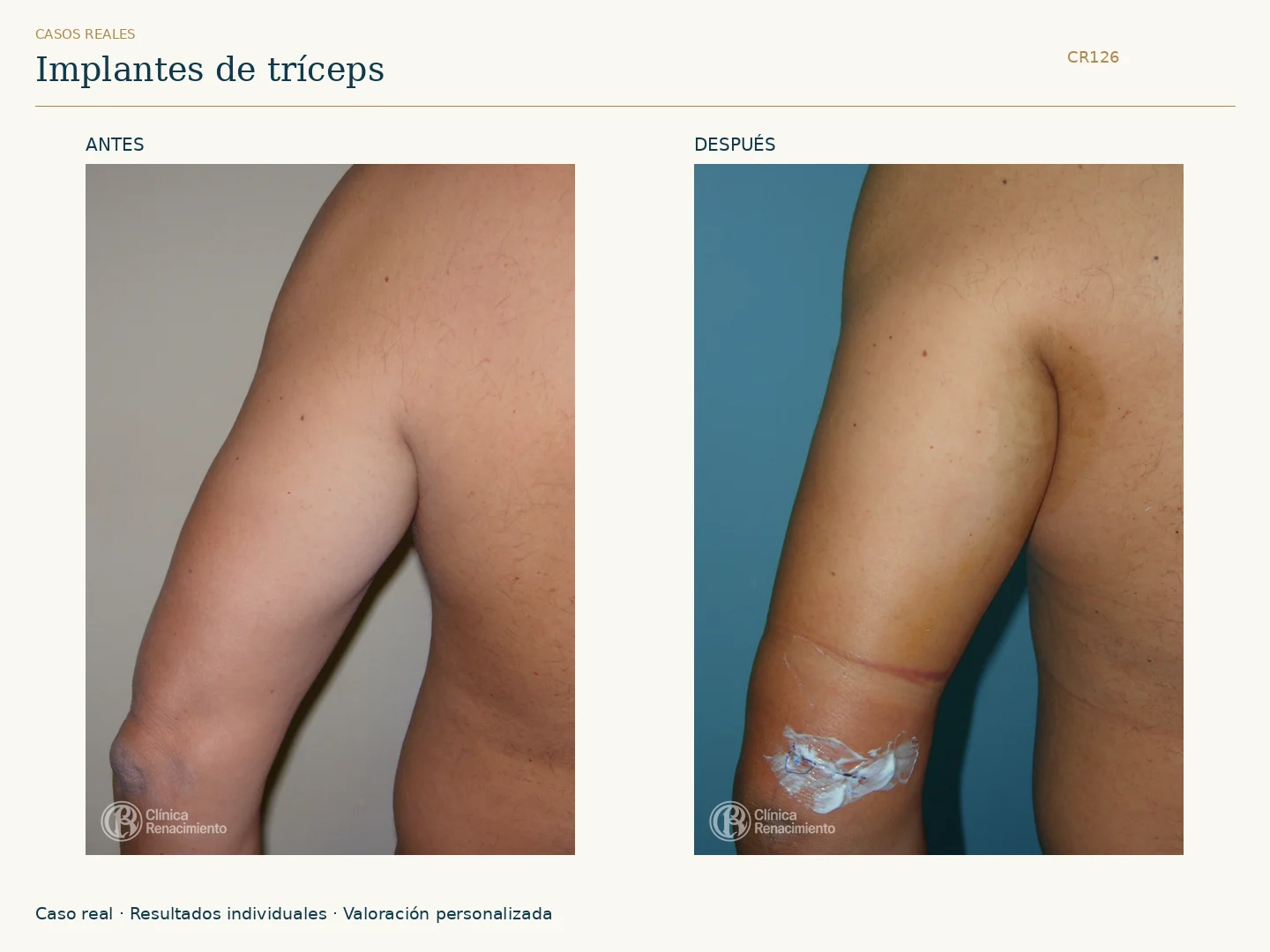 Tríceps: antes y después, vista posterior brazo. Caso CR126 de Clínica Renacimiento Madrid.
