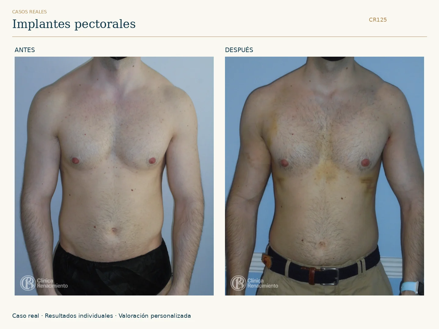 Prótesis de Pectorales: antes y después, vista frontal. Caso CR125 de Clínica Renacimiento Madrid.