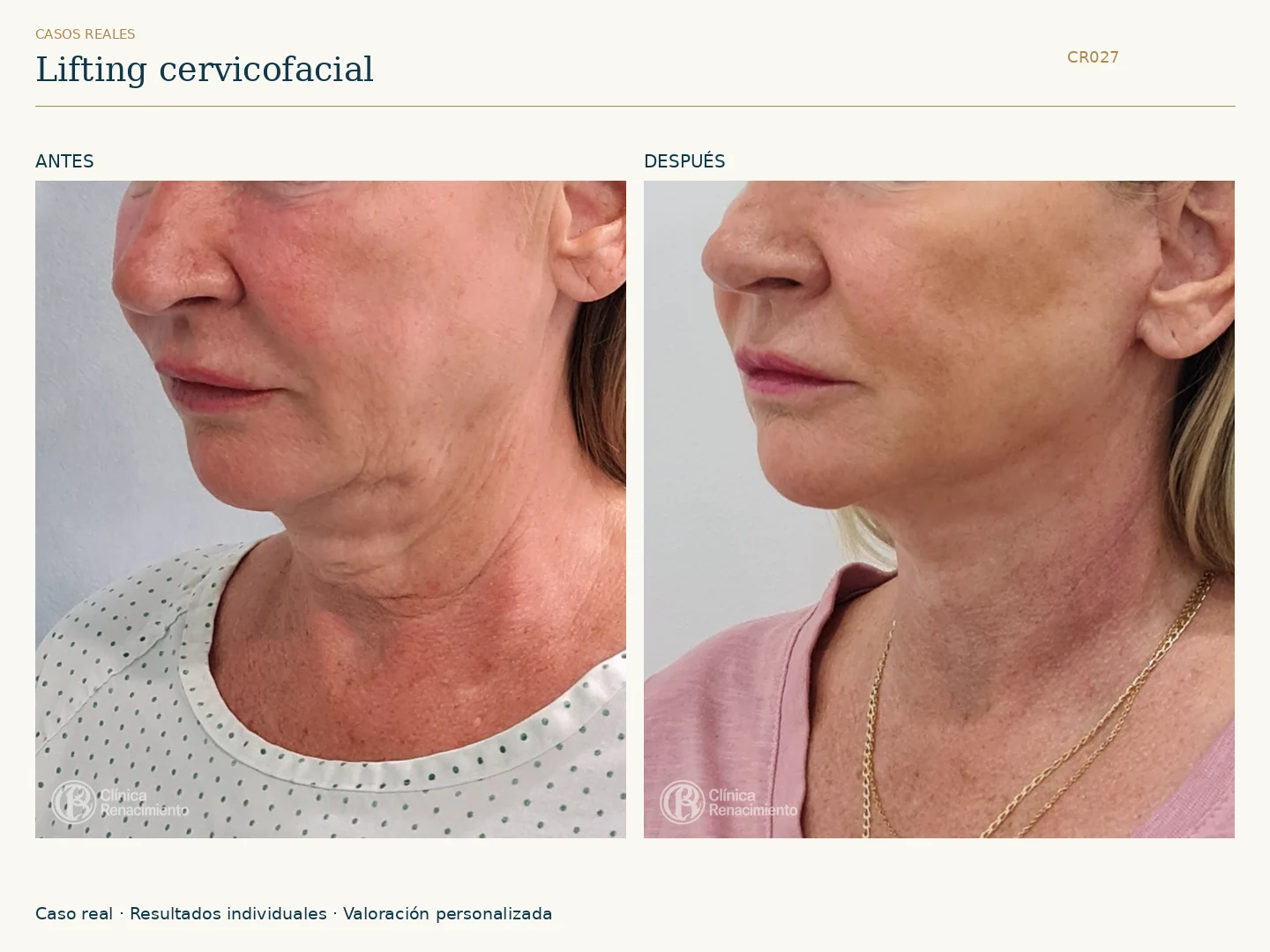 Lifting facial: antes y después, vista oblicua izquierda. Caso CR027 de Clínica Renacimiento Madrid.
