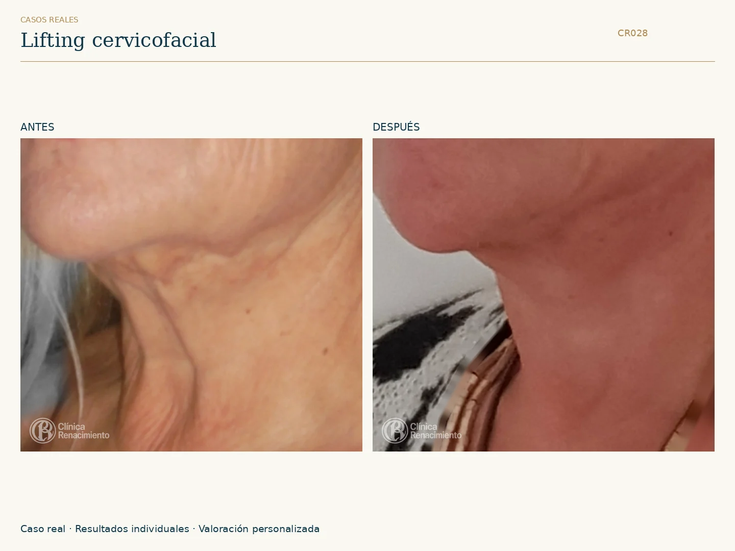 Lifting de cuello: antes y después, vista oblicua izquierda. Caso CR028 de Clínica Renacimiento Madrid.