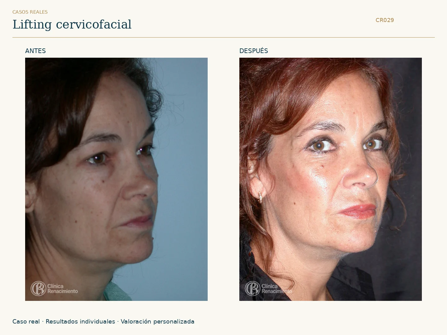 Pómulos: antes y después, vista oblicua derecha pomulos. Caso CR029 de Clínica Renacimiento Madrid.