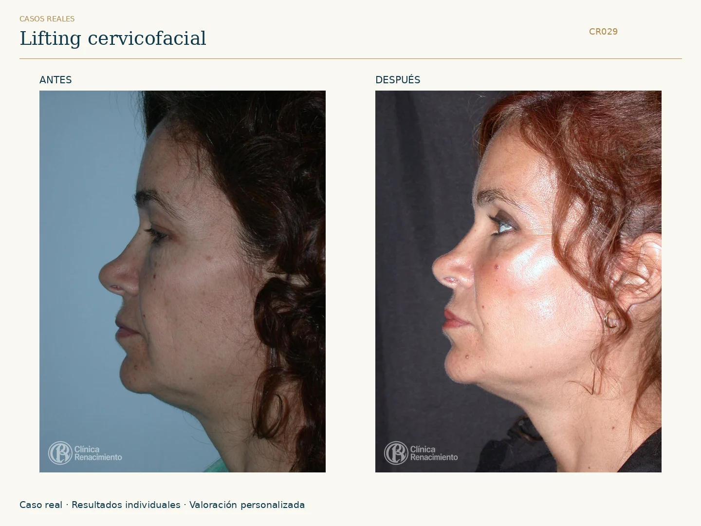 Lifting facial: antes y después, vista perfil izquierdo. Caso CR029 de Clínica Renacimiento Madrid.
