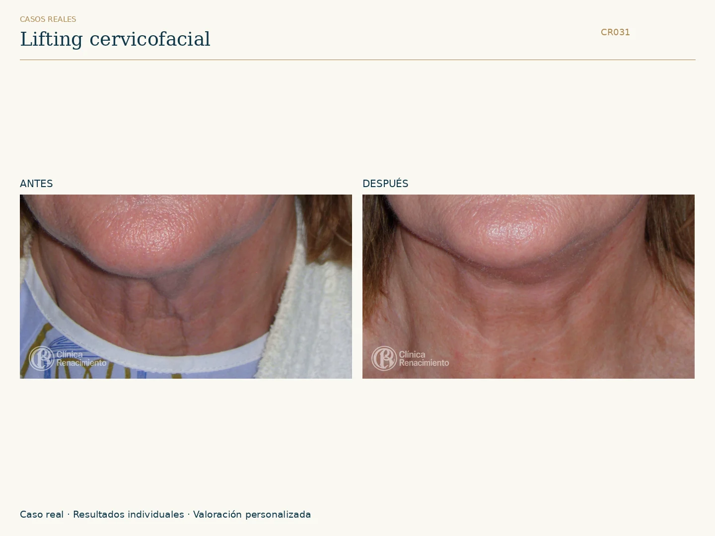 Lifting de cuello: antes y después, vista frontal. Caso CR031 de Clínica Renacimiento Madrid.