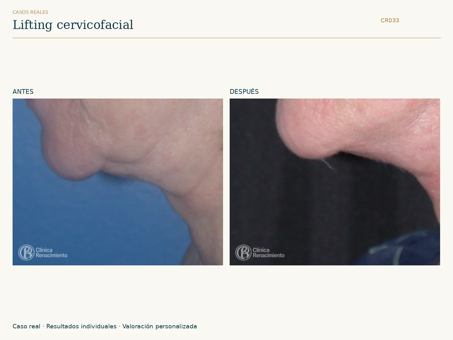 Lifting facial: antes y después, vista perfil izquierdo. Caso CR033 de Clínica Renacimiento Madrid.