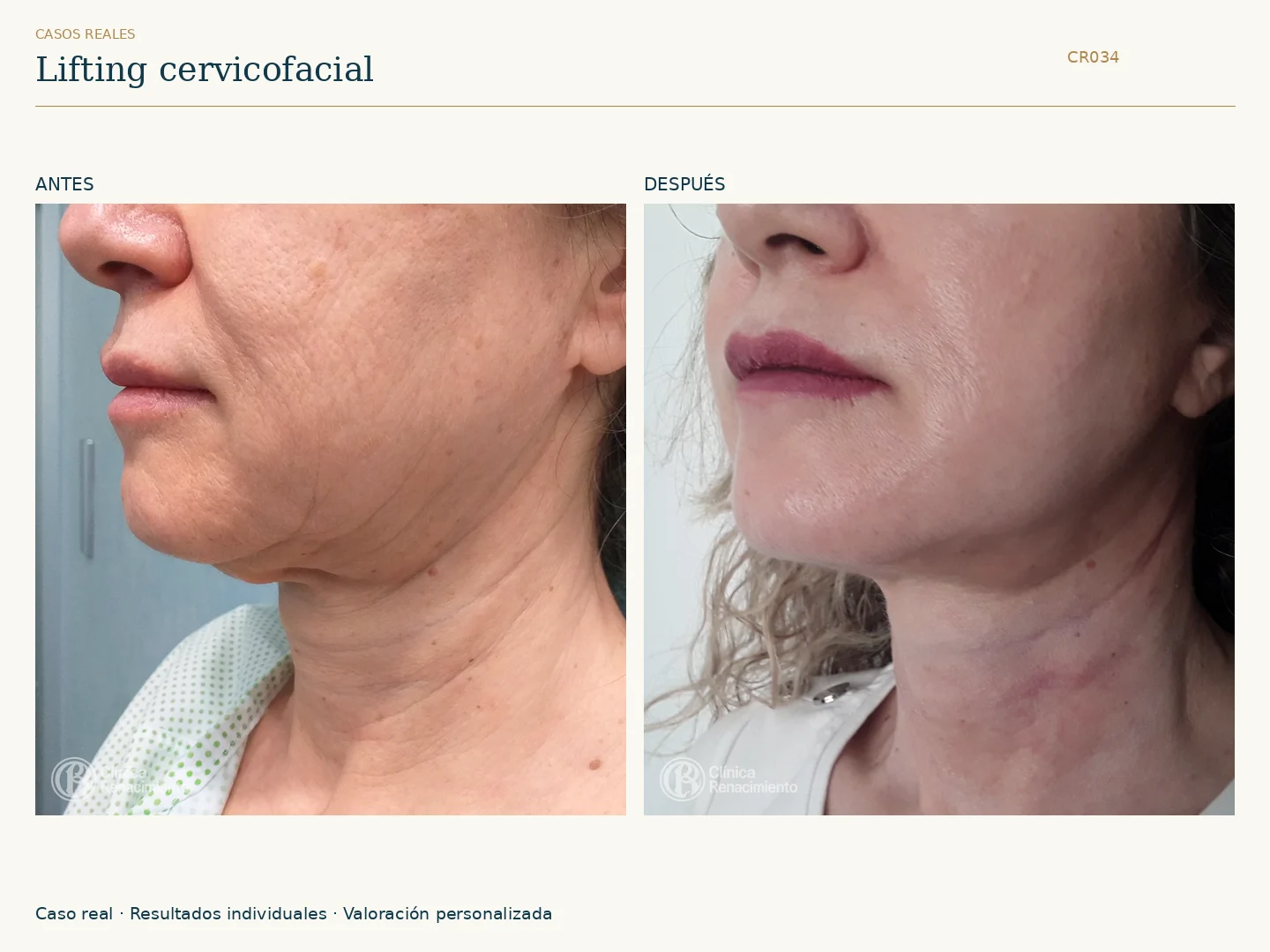 Lifting facial: antes y después, vista oblicua izquierda. Caso CR034 de Clínica Renacimiento Madrid.