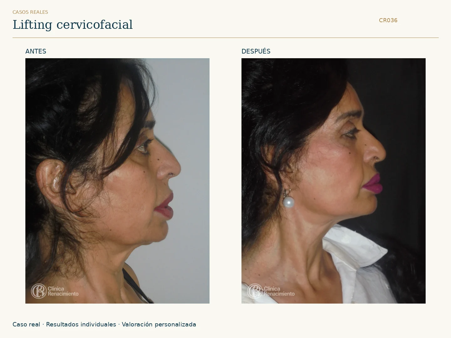 Lifting facial: antes y después, vista perfil derecho. Caso CR036 de Clínica Renacimiento Madrid.