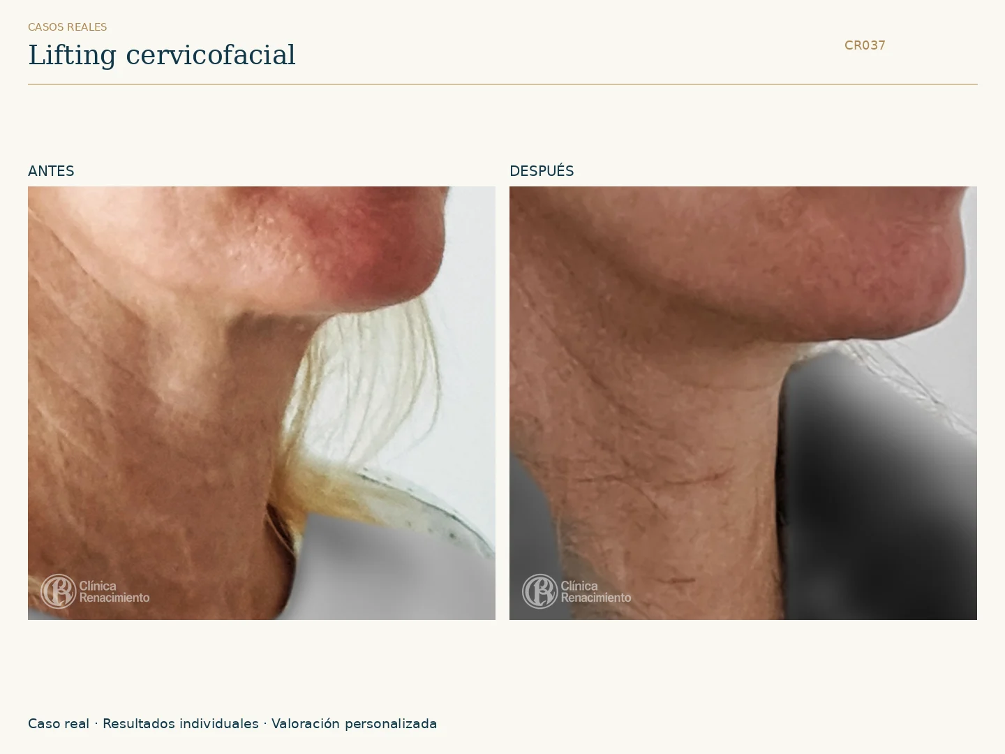 Lifting facial: antes y después, vista oblicua derecha. Caso CR037 de Clínica Renacimiento Madrid.