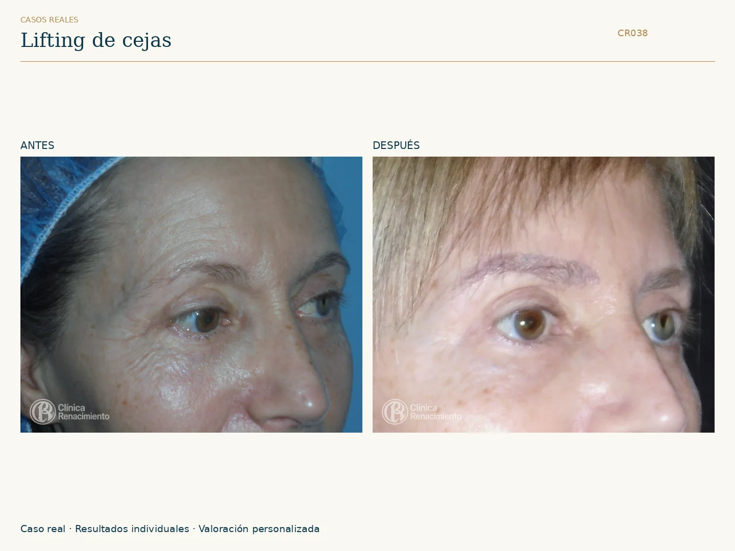 Lifting de cejas: antes y después, vista oblicua derecha. Caso CR038 de Clínica Renacimiento Madrid.