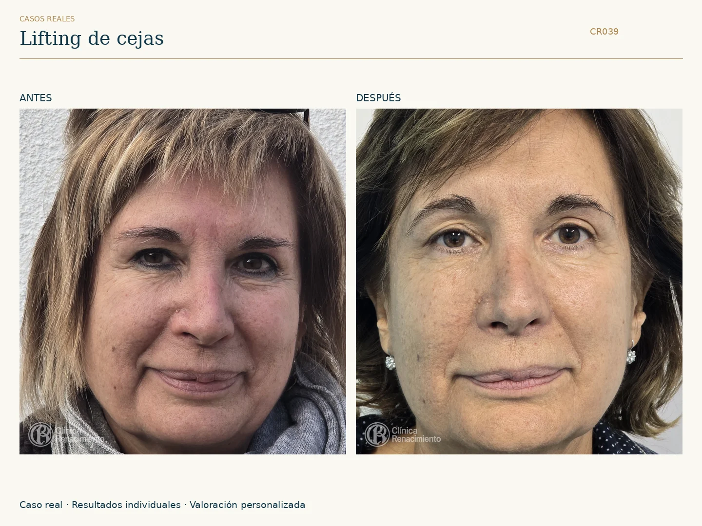 Lifting de cejas: antes y después, vista frontal. Caso CR039 de Clínica Renacimiento Madrid.