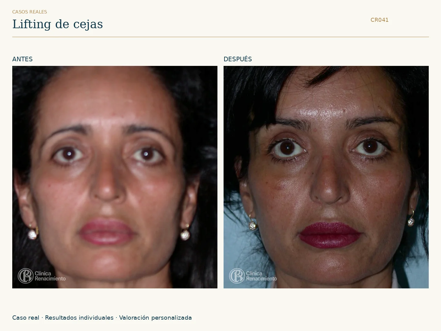 Lifting de cejas: antes y después, vista frontal. Caso CR041 de Clínica Renacimiento Madrid.