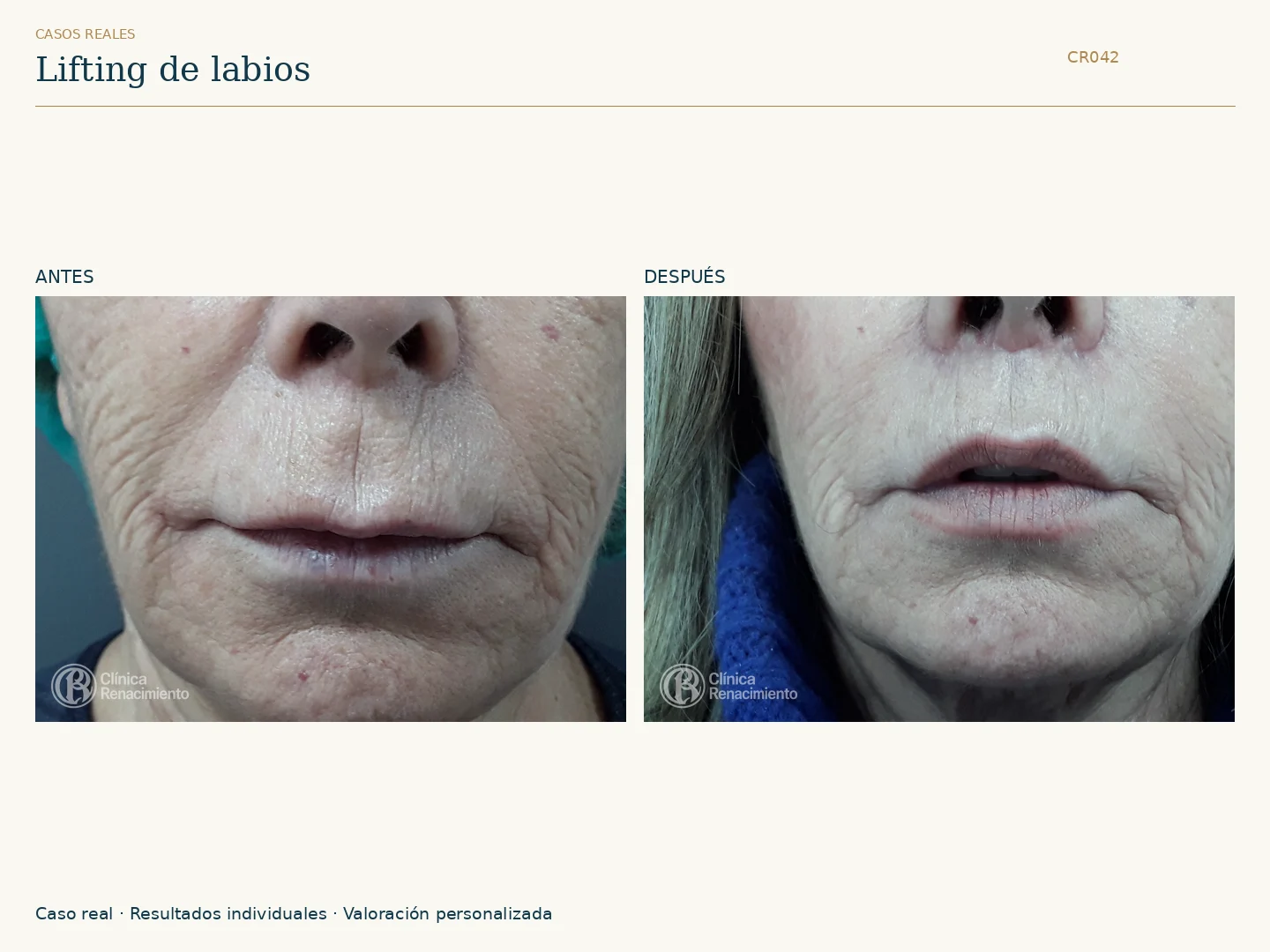 Lifting de labios: antes y después, vista frontal. Caso CR042 de Clínica Renacimiento Madrid.