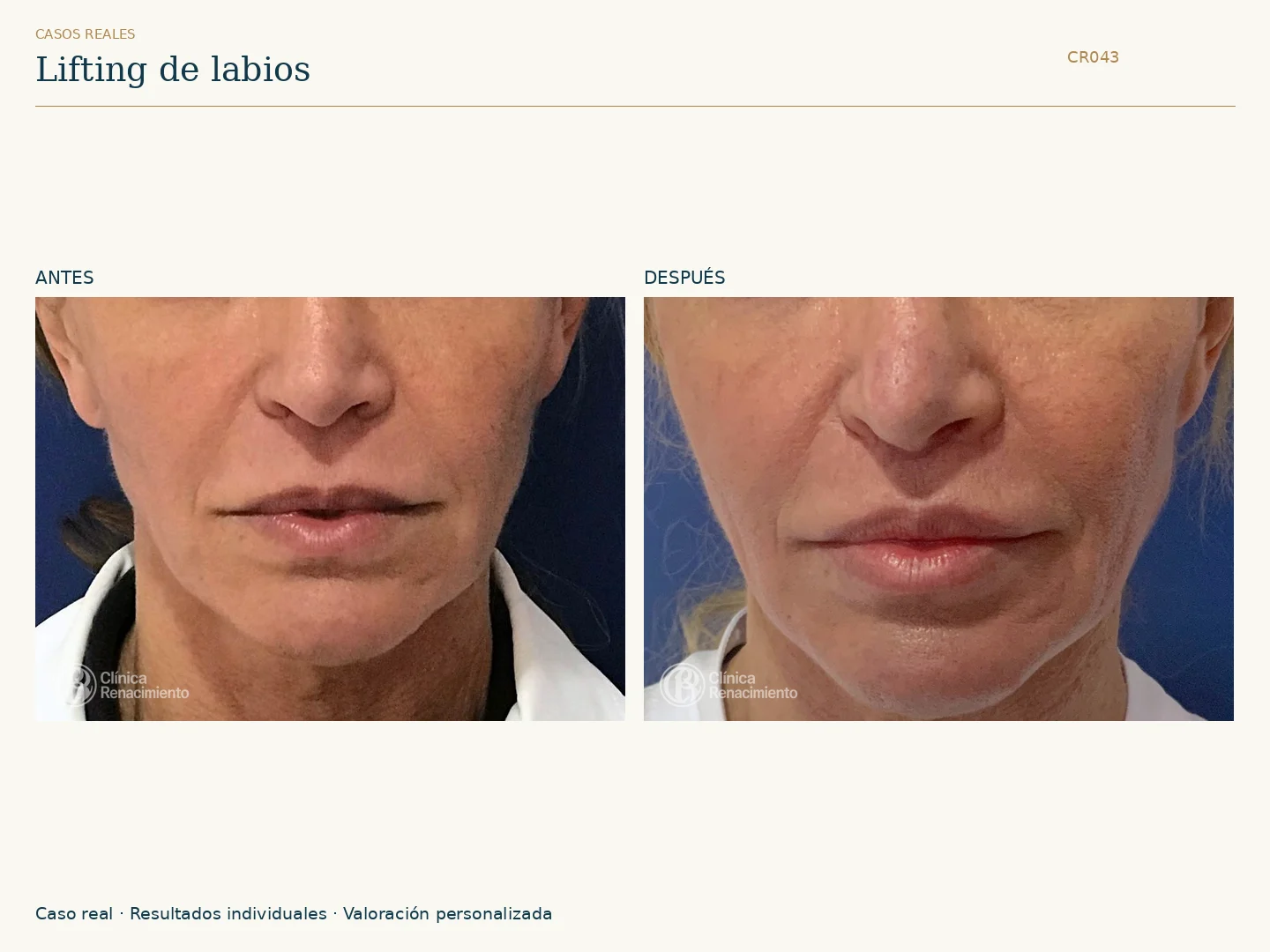 Lifting de labios: antes y después, vista frontal. Caso CR043 de Clínica Renacimiento Madrid.