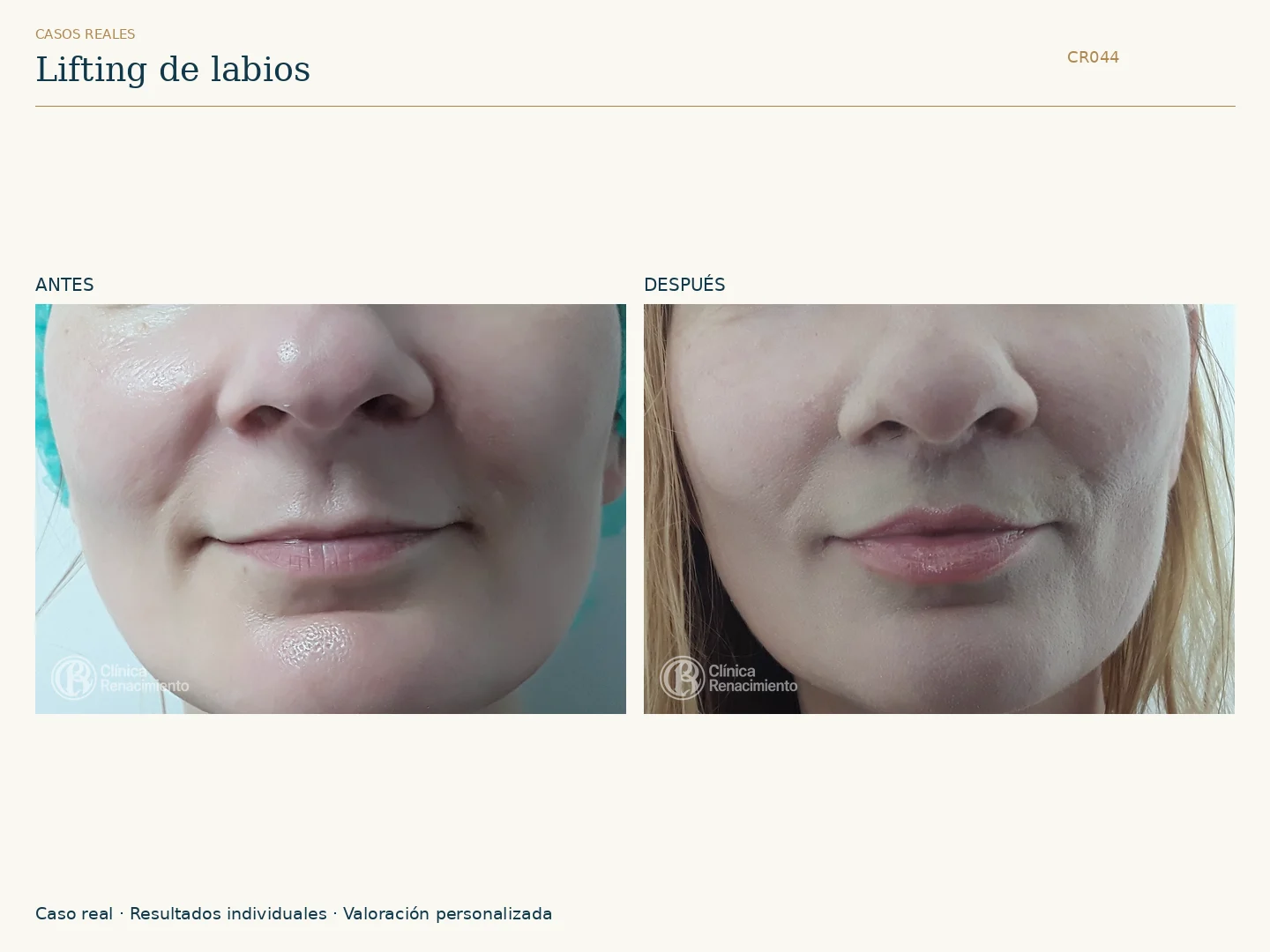 Lifting de labios: antes y después, vista frontal. Caso CR044 de Clínica Renacimiento Madrid.