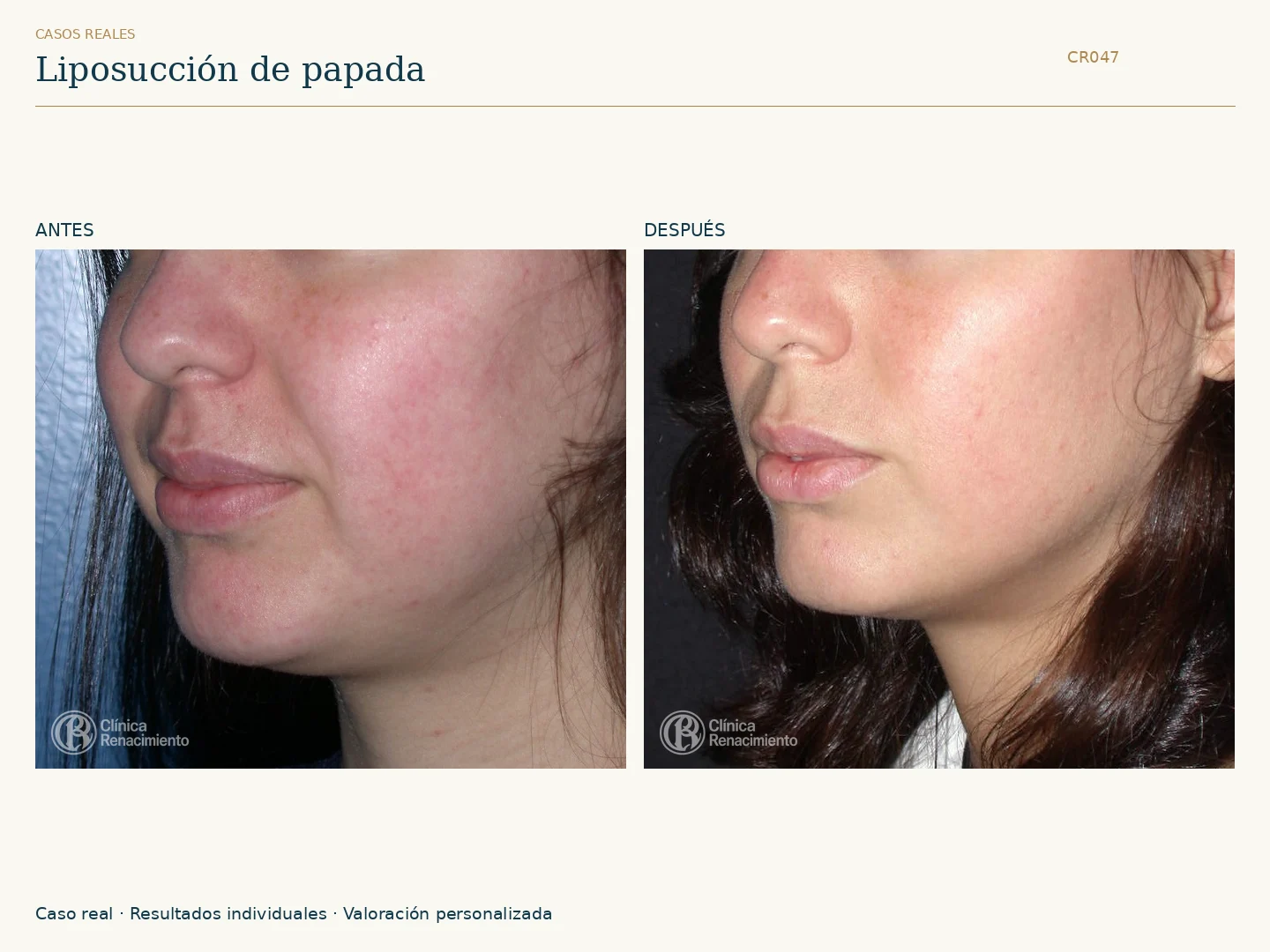 Lipoescultura de Papada: antes y después, vista oblicua izquierda. Caso CR047 de Clínica Renacimiento Madrid.