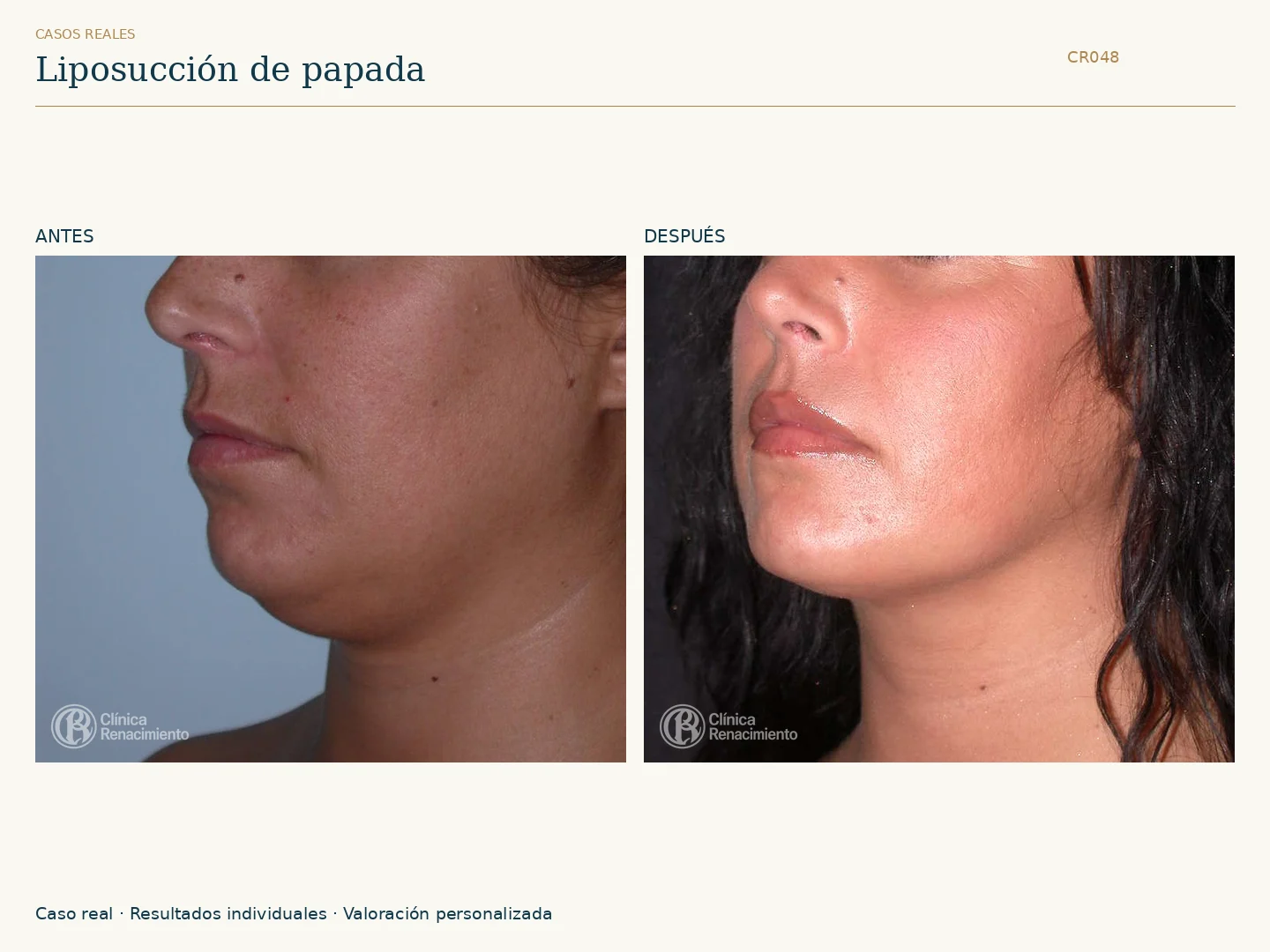Lipoescultura de Papada: antes y después, vista oblicua izquierda. Caso CR048 de Clínica Renacimiento Madrid.
