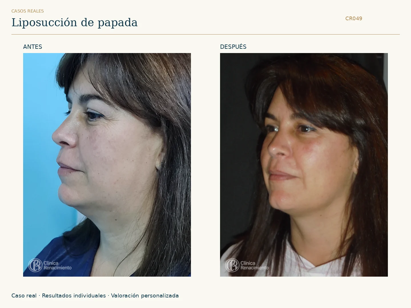 Lipoescultura de Papada: antes y después, vista oblicua izquierda. Caso CR049 de Clínica Renacimiento Madrid.