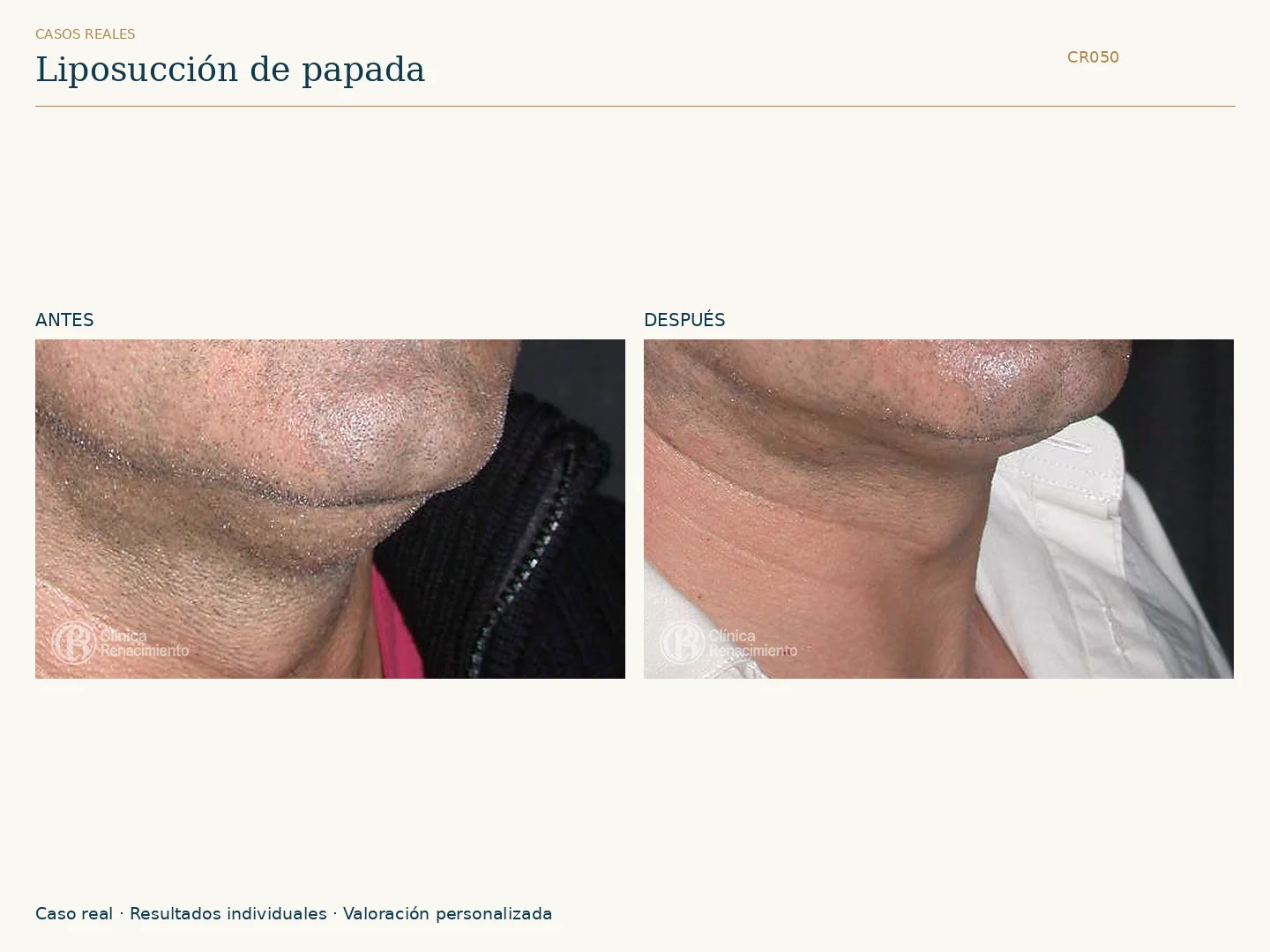 Lipoescultura de Papada: antes y después, vista oblicua derecha. Caso CR050 de Clínica Renacimiento Madrid.