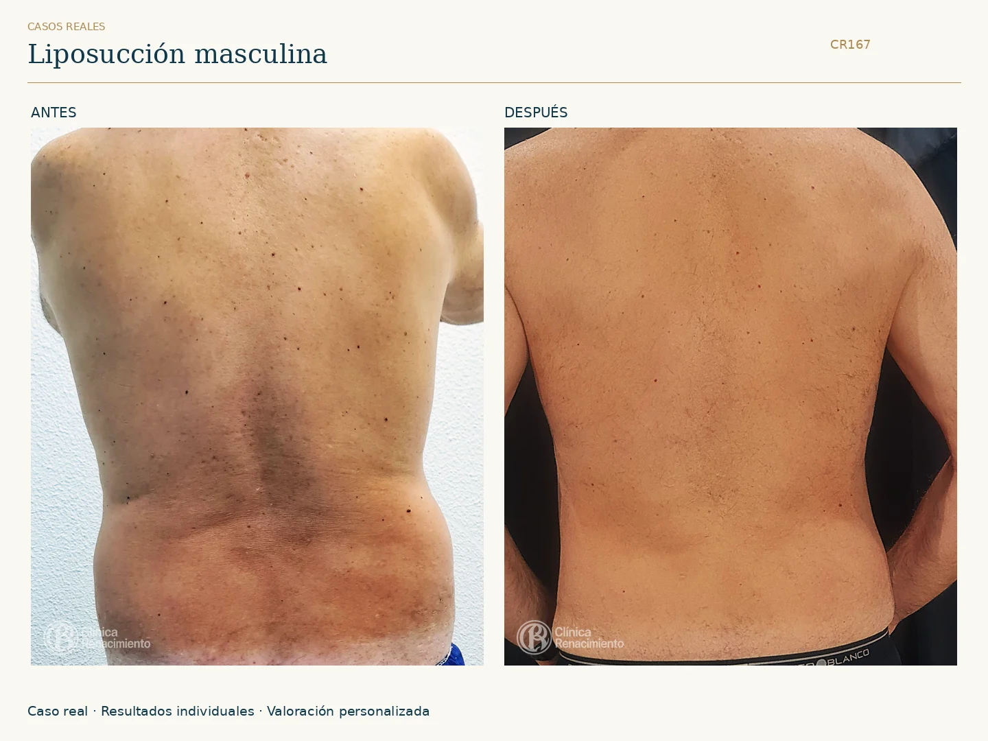 Lipoescultura: antes y después, vista posterior. Caso CR167 de Clínica Renacimiento Madrid.