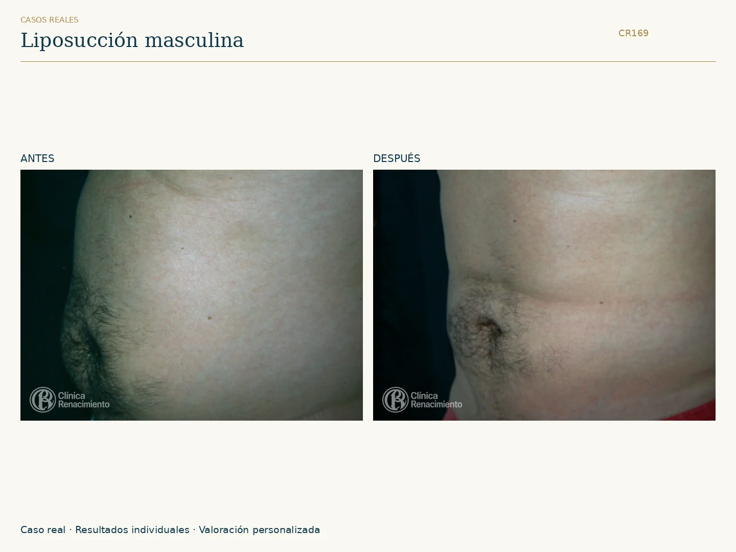 Lipoescultura: antes y después, vista perfil. Caso CR169 de Clínica Renacimiento Madrid.