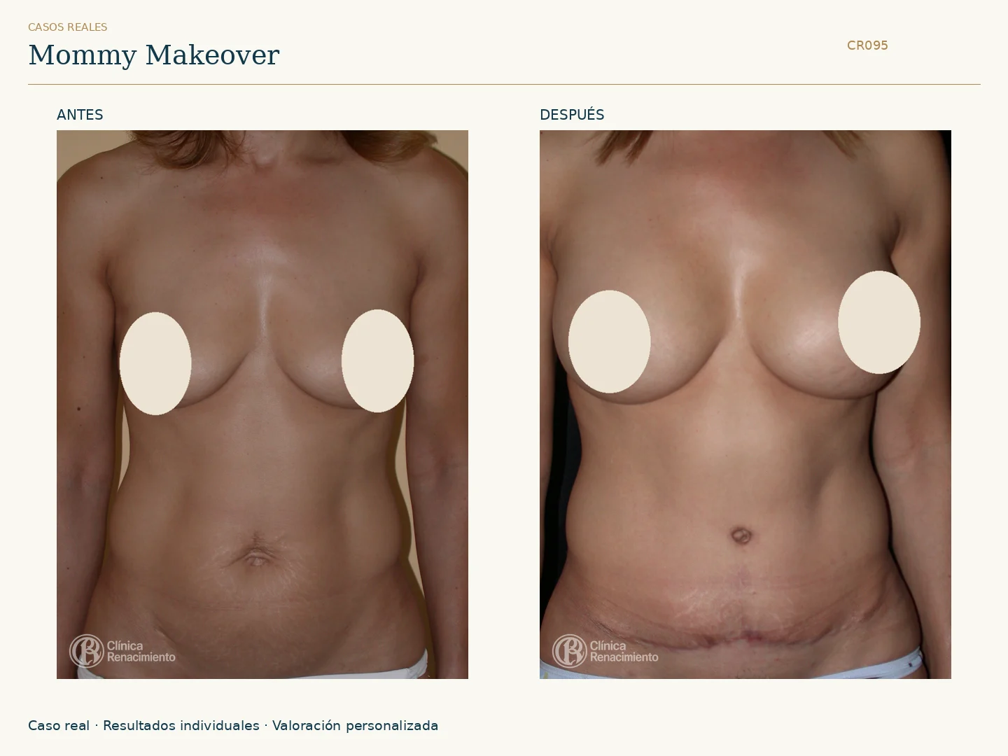 Mommy Makeover: antes y después, vista frontal. Caso CR095 de Clínica Renacimiento Madrid.