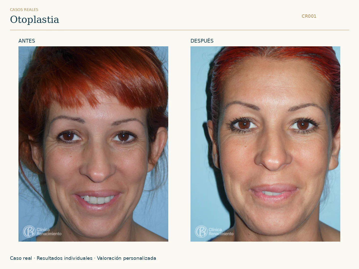 Orejas: antes y después, vista frontal. Caso CR001 de Clínica Renacimiento Madrid.