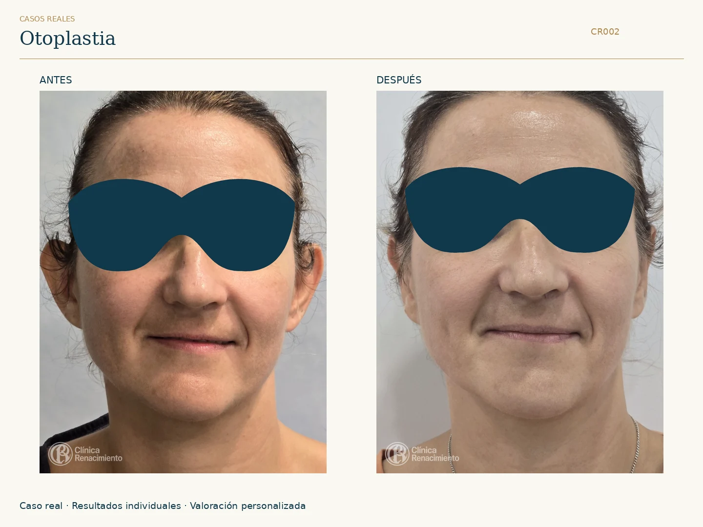 Orejas: antes y después, vista frontal. Caso CR002 de Clínica Renacimiento Madrid.