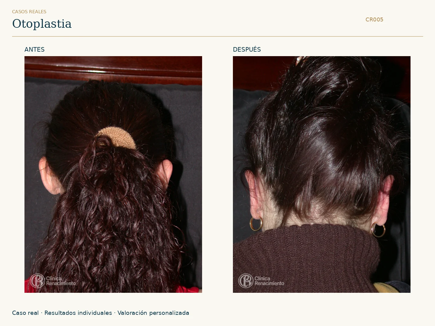 Orejas: antes y después, vista posterior 2003 2004. Caso CR005 de Clínica Renacimiento Madrid.