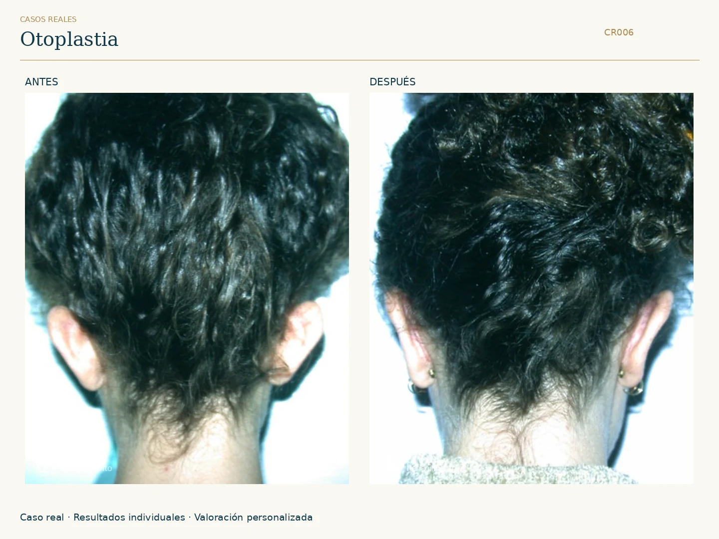 Orejas: antes y después, vista posterior. Caso CR006 de Clínica Renacimiento Madrid.
