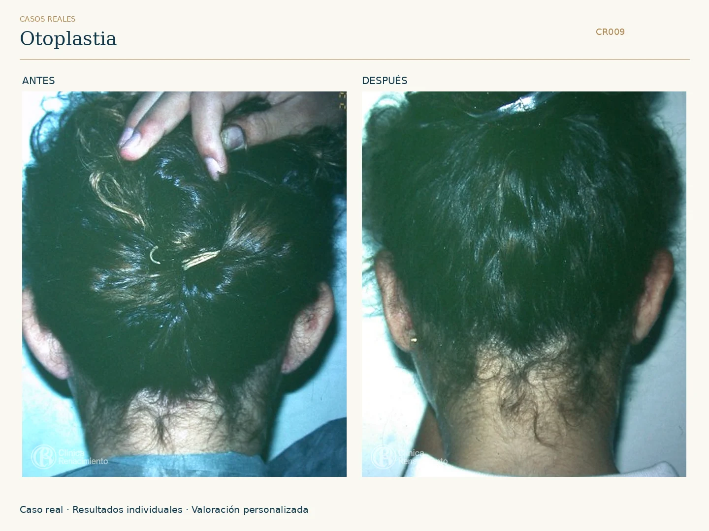 Orejas: antes y después, vista posterior. Caso CR009 de Clínica Renacimiento Madrid.