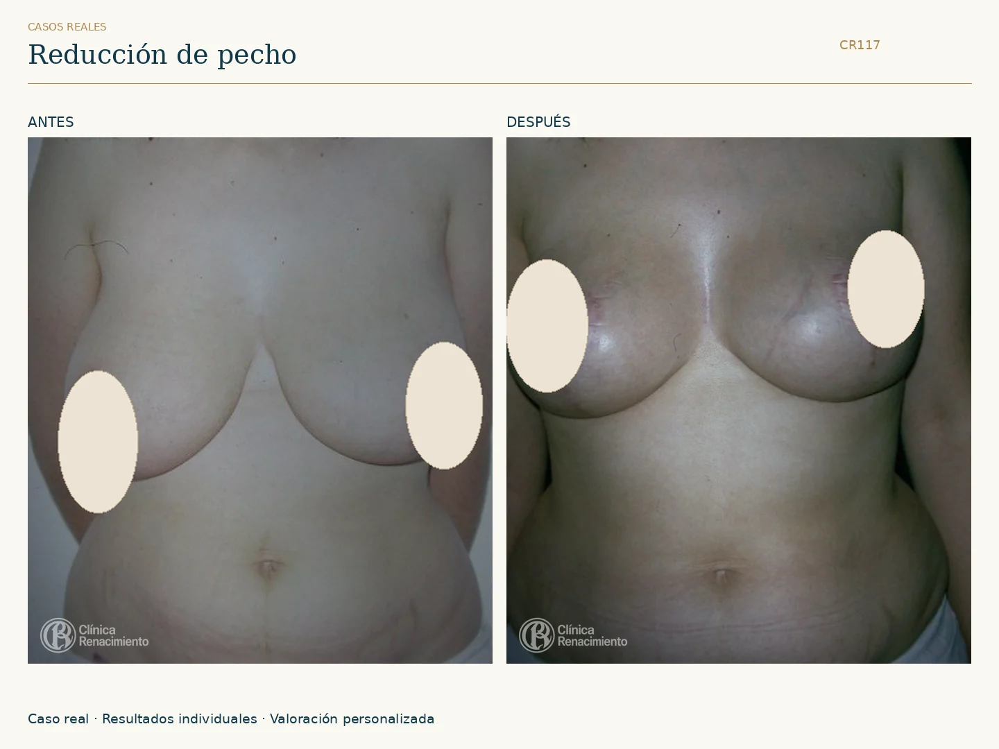 Reducción de senos: antes y después, vista frontal. Caso CR117 de Clínica Renacimiento Madrid.