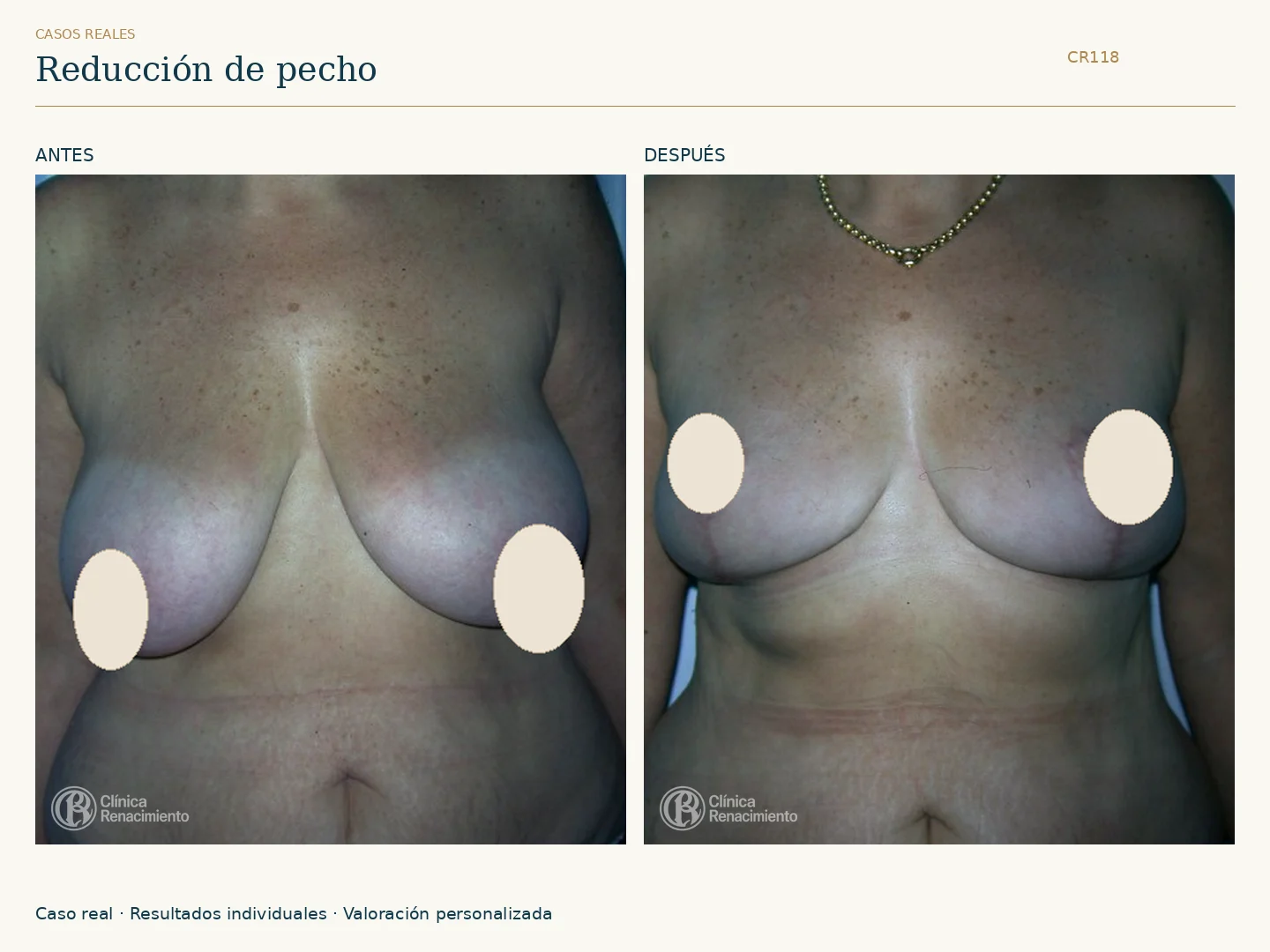 Reducción de senos: antes y después, vista frontal. Caso CR118 de Clínica Renacimiento Madrid.