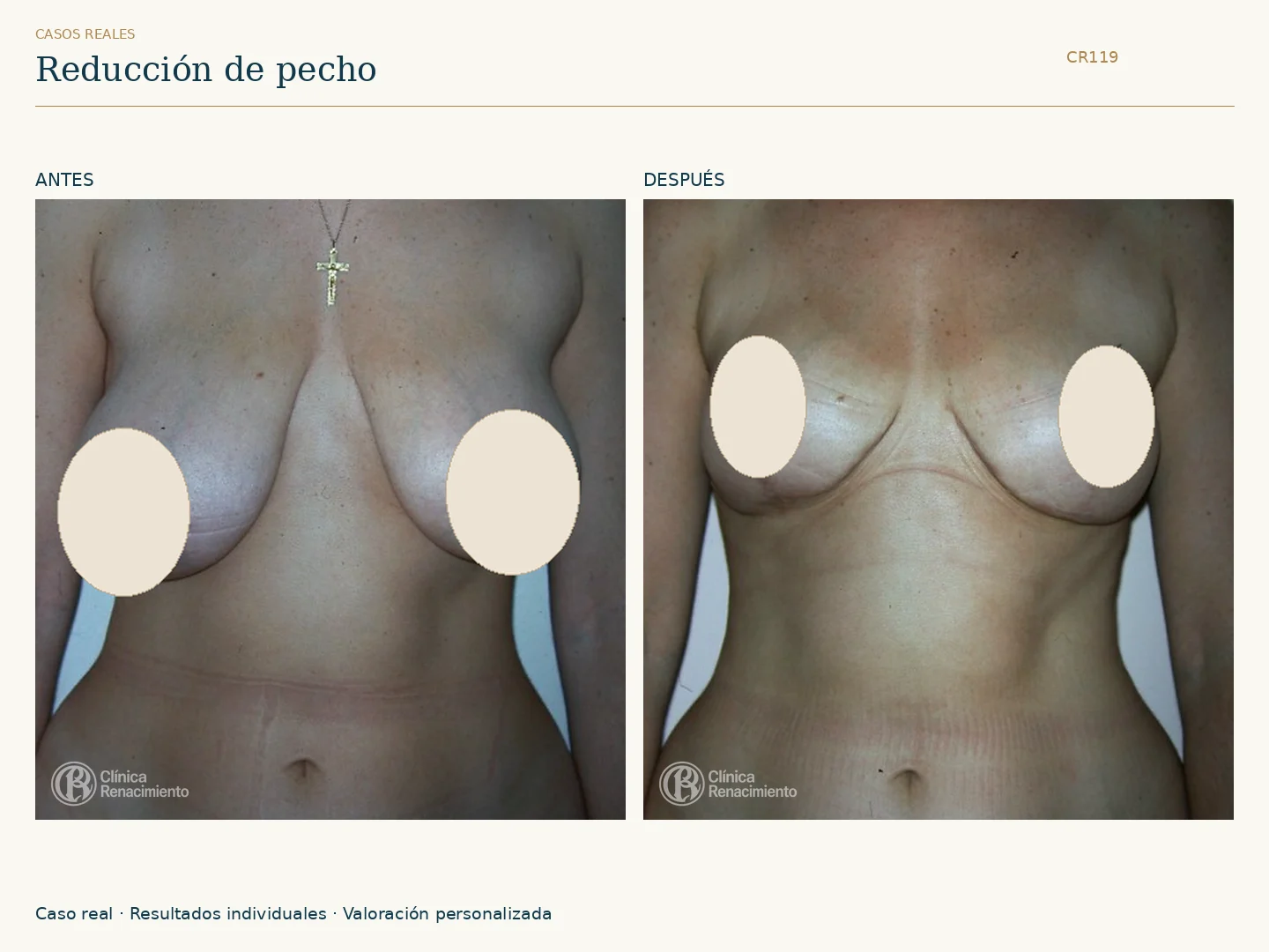 Reducción de senos: antes y después, vista frontal. Caso CR119 de Clínica Renacimiento Madrid.
