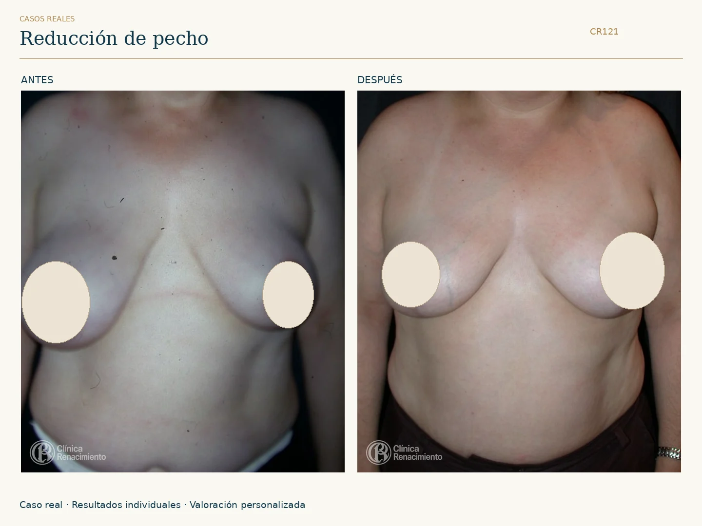 Reducción de senos: antes y después, vista frontal. Caso CR121 de Clínica Renacimiento Madrid.