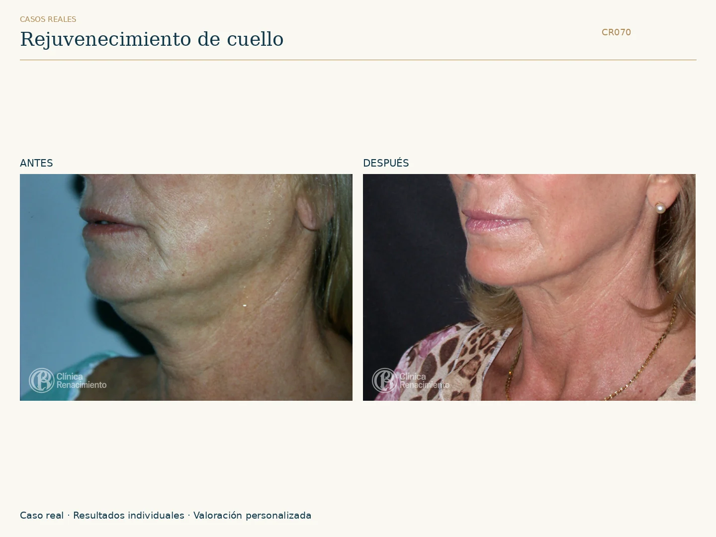 Rejuvenecimiento de Cuello: antes y después, vista oblicua izquierda. Caso CR070 de Clínica Renacimiento Madrid.