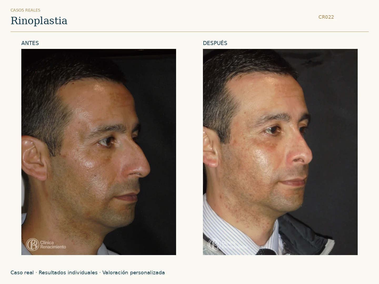 Nariz: antes y después, vista oblicua izquierda. Caso CR022 de Clínica Renacimiento Madrid.