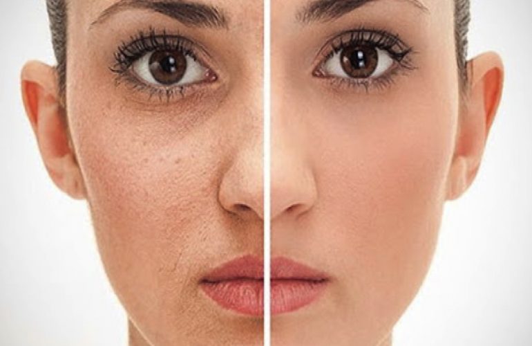 imagen de Rejuvenecimiento con Láser C02 clinica renacimiento madrid y marbella estetica facial