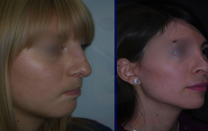 bolas bichat renacimiento (1)