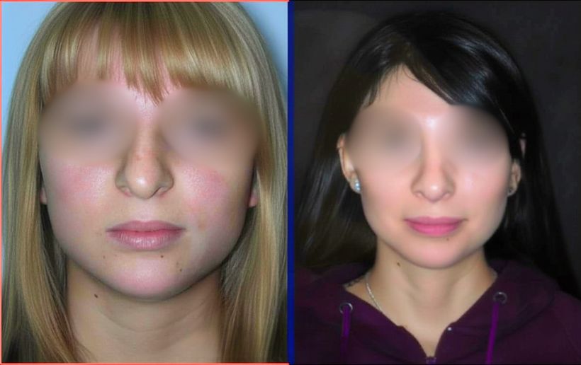 bolas bichat renacimiento