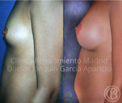 imagen de caso antes y despues real aumento de seno clinica renacimiento madrid 3