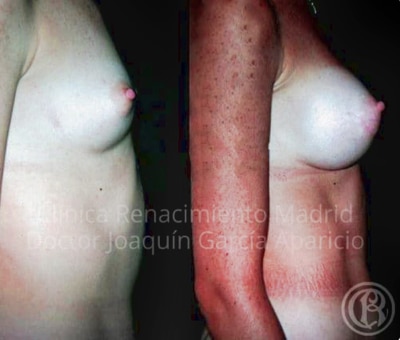 imagen de caso real antes y despues aumento de senos clinica renacimiento madrid 15