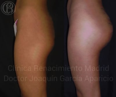 imagen de caso real antes y despues protesis de gluteos clinica renacimiento madrid 2
